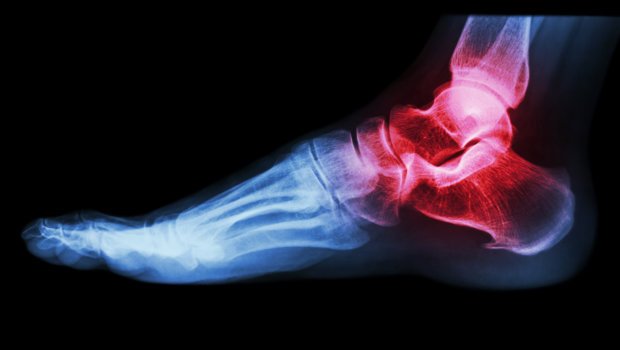 x-ray of human ankle with arthritis